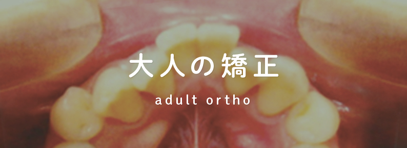 大人の矯正 adult ortho